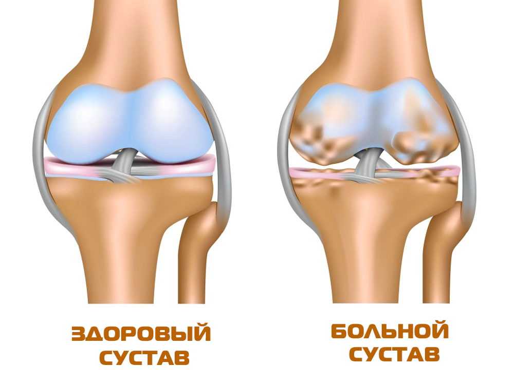 Лечение хряща коленного сустава