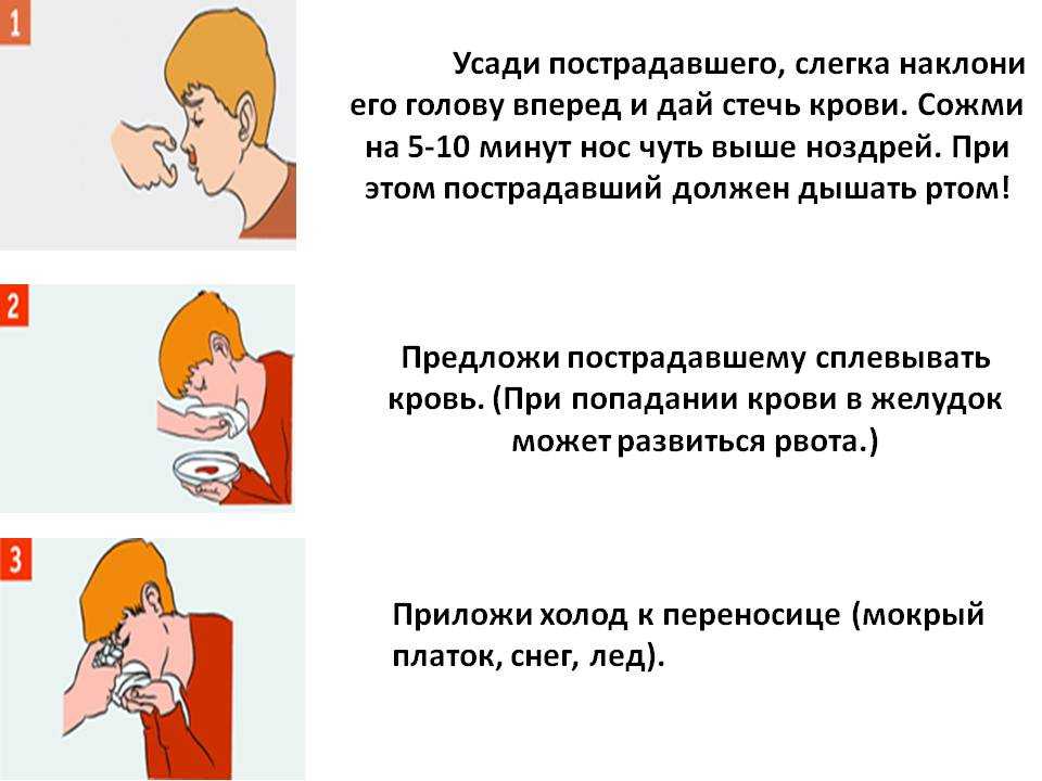 Что необходимо сделать при носовом капиллярном кровотечении. При носовом кровотечении у пострадавшего необходимо. При кровотечении из носа пострадавшего. Носовое кровотечение памятка. Капиллярное кровотечение из носа.