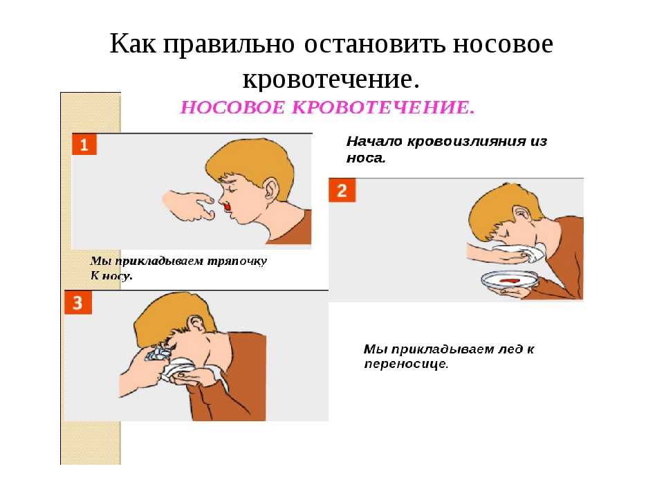 Первая помощь при носовом кровотечении. Остановка носового кровотечения. Остановить носоовое крово. Как Остановить носовое кровотечение. Как правильно останавливать носовое кровотечение.